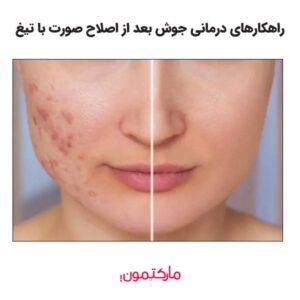 راهکار برای درمان جوش بعد از اصلاح صورت