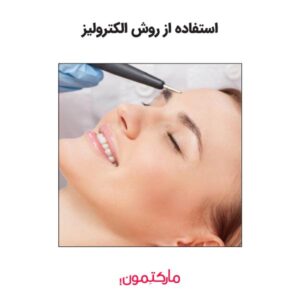 استفاده از روش الکترولیز برای اصلاح صورت